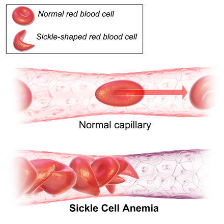 Diagram showing normal vs. sickle-shaped red blood cells