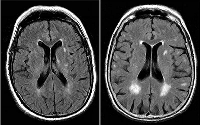 MRI scan showing white matter hyperintensities in elderly patients